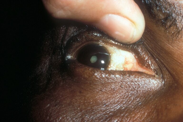 Côte d’Ivoire-AIP/Une campagne de chirurgie gratuite de la cataracte en cours dans la région sanitaire de l’Agneby-Tiassa