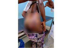 Côte d’Ivoire-AIP/ Une fille brûlée aux fesses et aux hanches après des accusations de sorcellerie à Ahoutoué