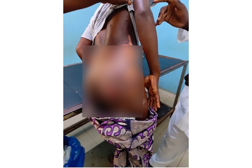 Côte d’Ivoire-AIP/ Une fille brûlée aux fesses et aux hanches après des accusations de sorcellerie à Ahoutoué